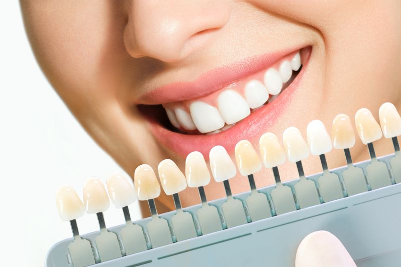 dental-veeners-niew.jpg