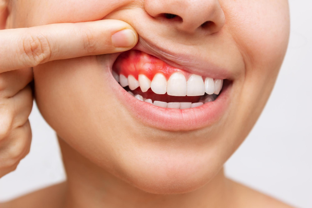 Diş Eti İltihabı Nasıl Tedavi Edilir
