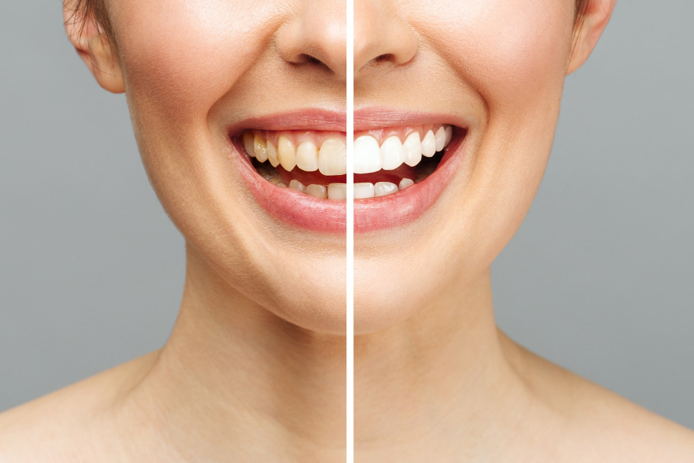 Diş Sararması Ve Nedenleri
