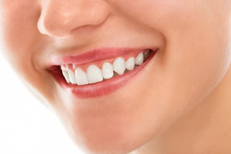 gummy-smile-nedir.jpg